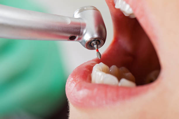 Best Emergency Wisdom Teeth Removal in Auburn, KY